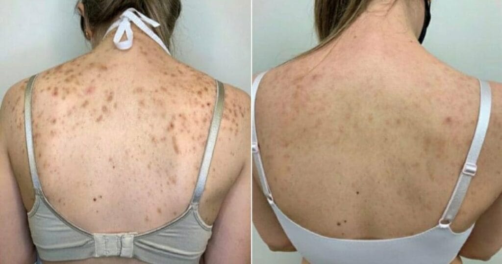 Manchas de Acne Tratamento