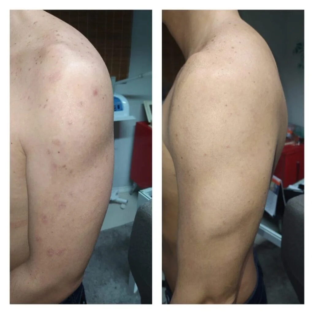 Manchas de Acne nos Braços - Tratamento com Peeling Químico