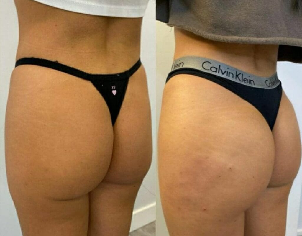 Modelar Glúteo com Preenchimento