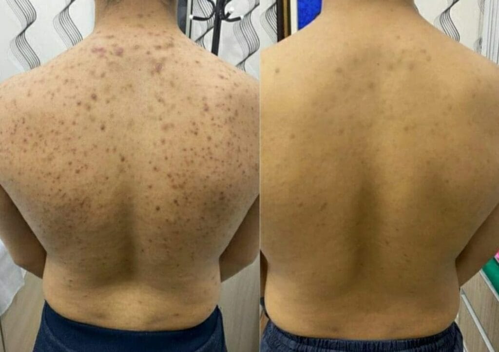 Peeling Quimico para Tratar Manchas nas Costas