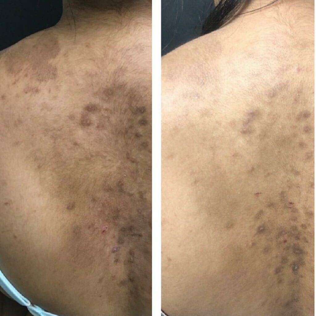 Peeling Químico para Tratar Manchas no Corpo