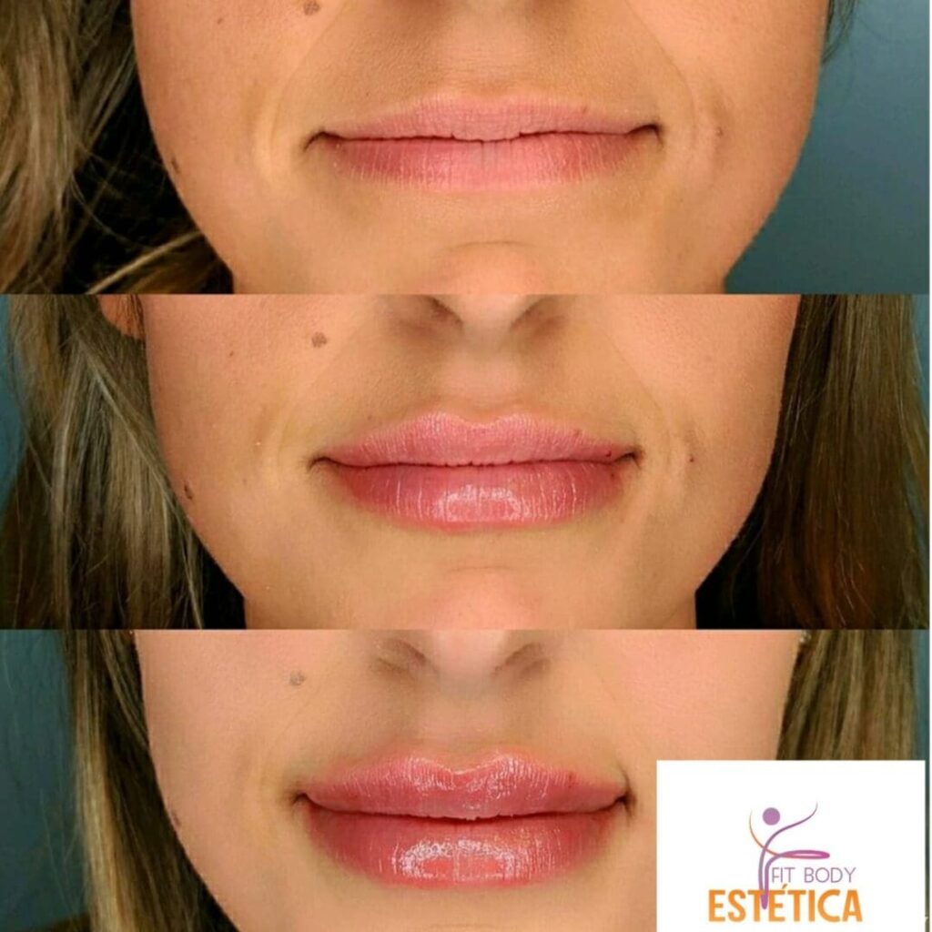 Preenchimento Labial Natural