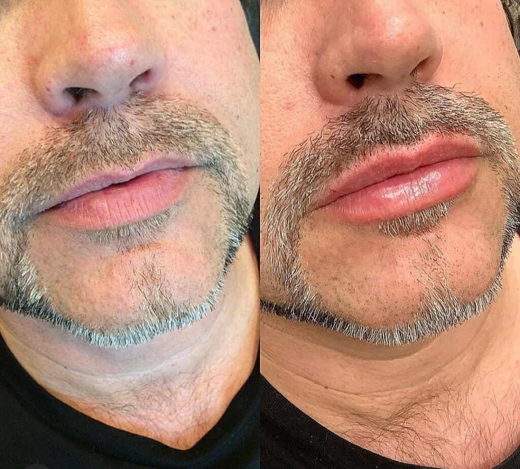 Preenchimento Labial para Homens