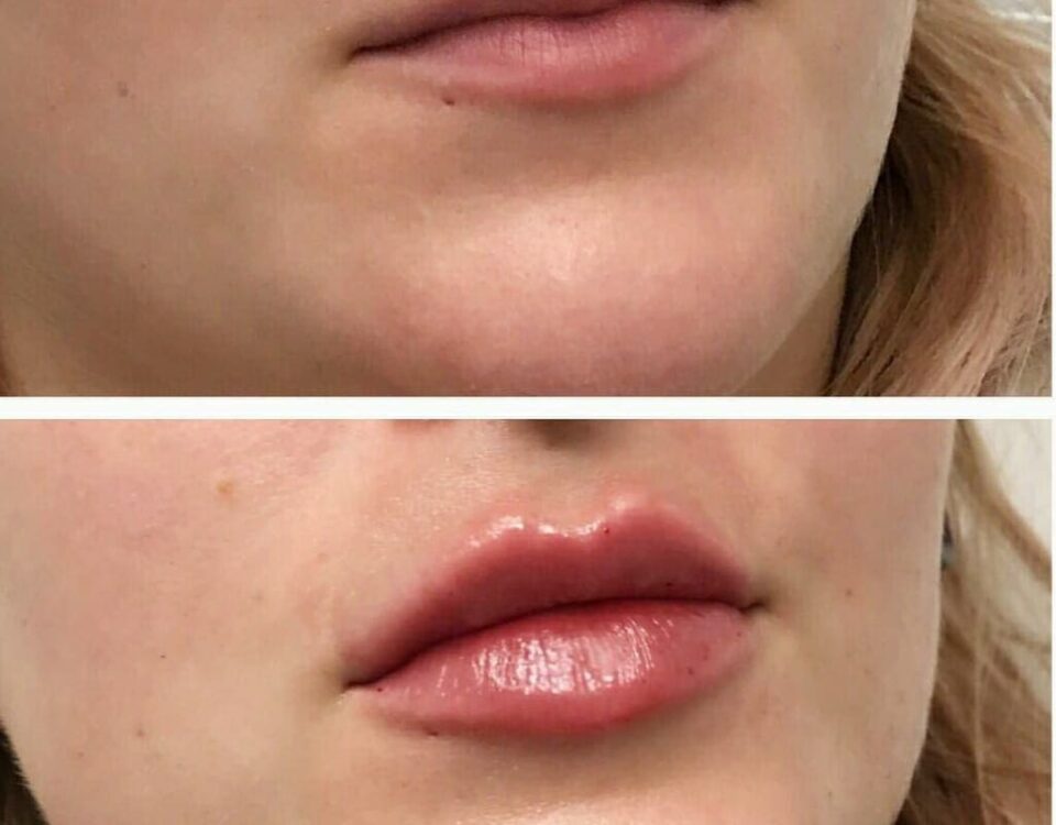 Preenchimento dos Labios Antes e Depois