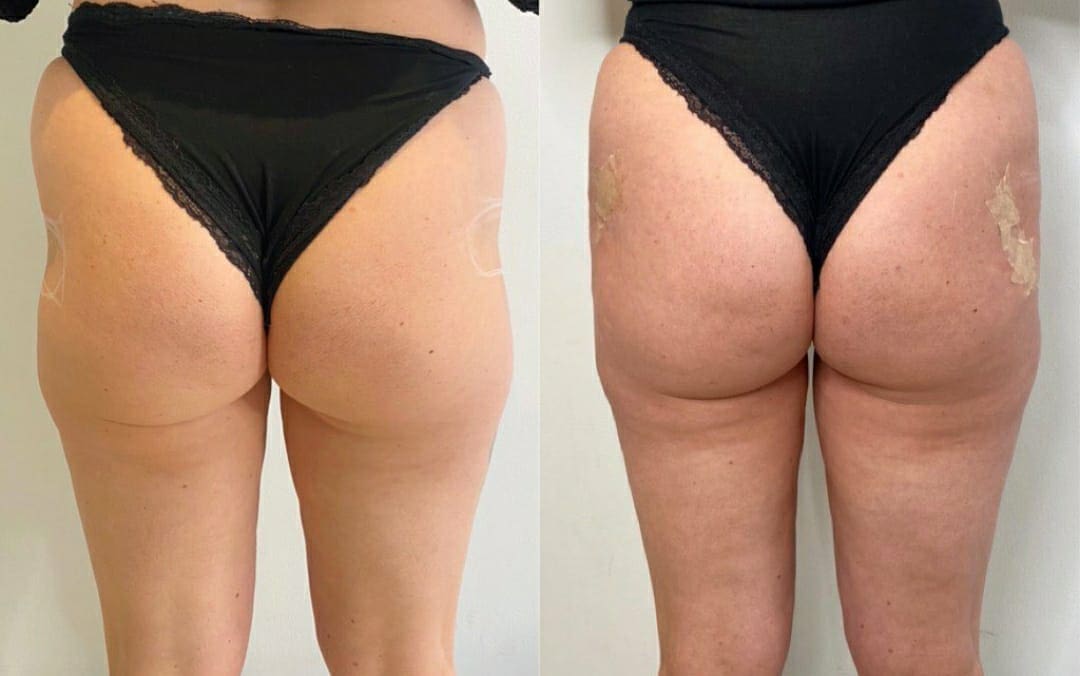 Clínica Especializada em Hip Dips - Clínica Fit Body Estética