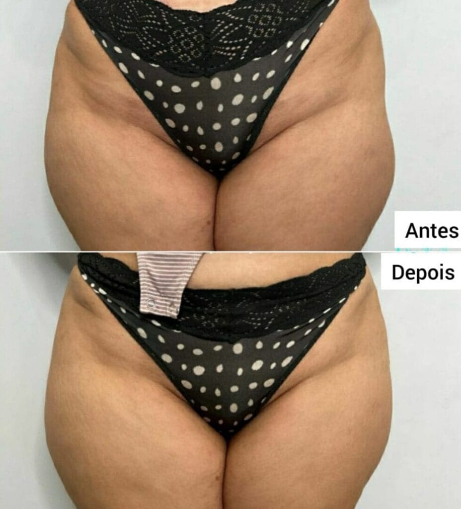 Preenchimento para Aumentar Lateral de Quadril