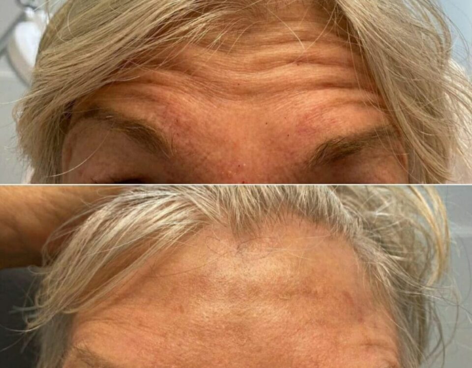 Rejuvenescimento Facial com Botox Antes e Depois
