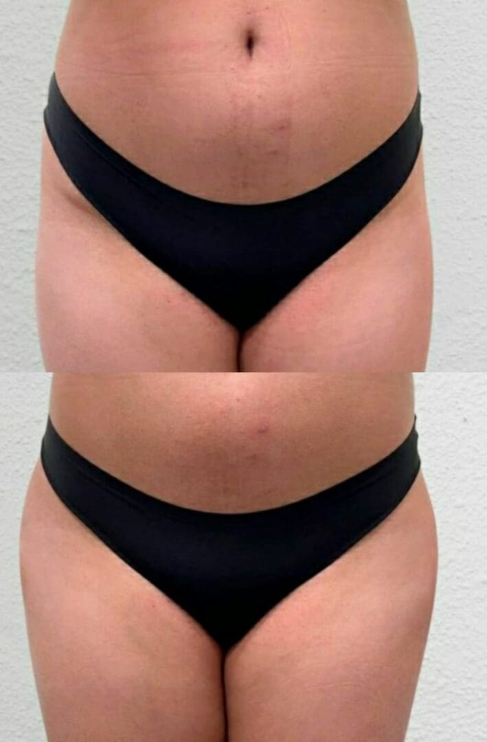 Clínica Especializada em Hip Dips - Clínica Fit Body Estética