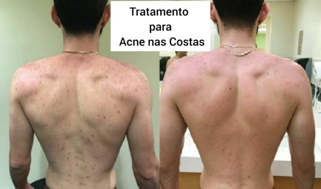 Tratamento para Acne e Manchas no Corpo