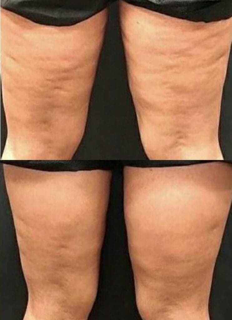 Tratamento para Celulite e Flacidez nas Pernas