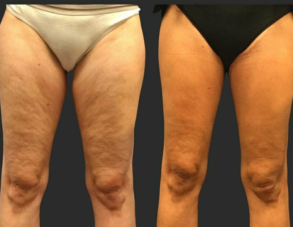 Tratamento para Flacidez nas Pernas Antes e Depois