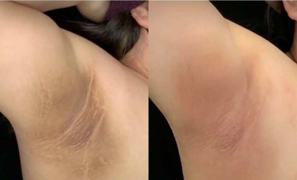 Tratamento para Manchas Escuras na Axila