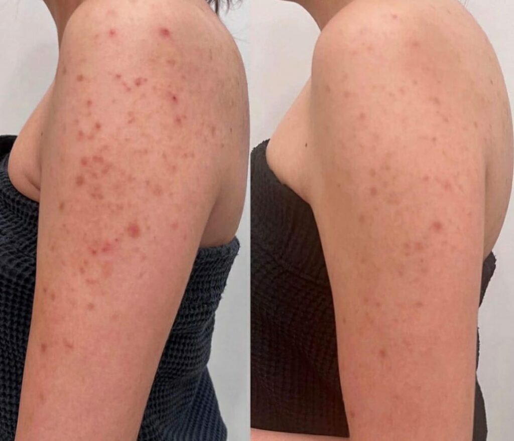 Tratamento para Manchas de Acne nos Bracos