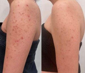 Tratamento para Manchas de Acne nos Braços