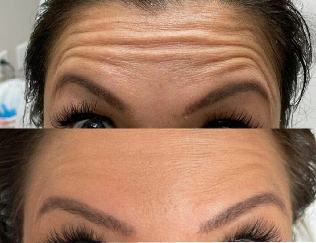 Tratamento para Rugas Antes e Depois