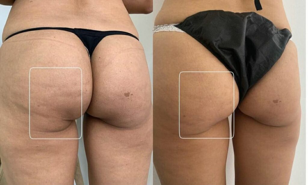 Radiesse no Glúteo Antes e Depois