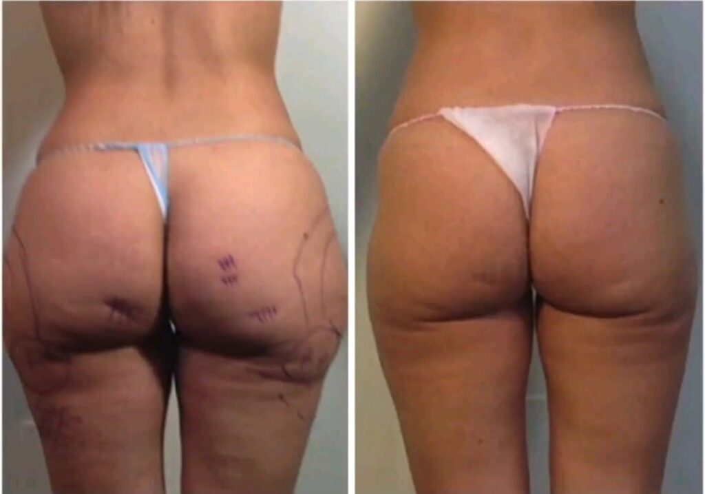 Tratamento para Celulite e Culote com Sculptra e Subcisão