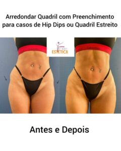 Arredondar Quadril com Preenchimento Antes e Depois