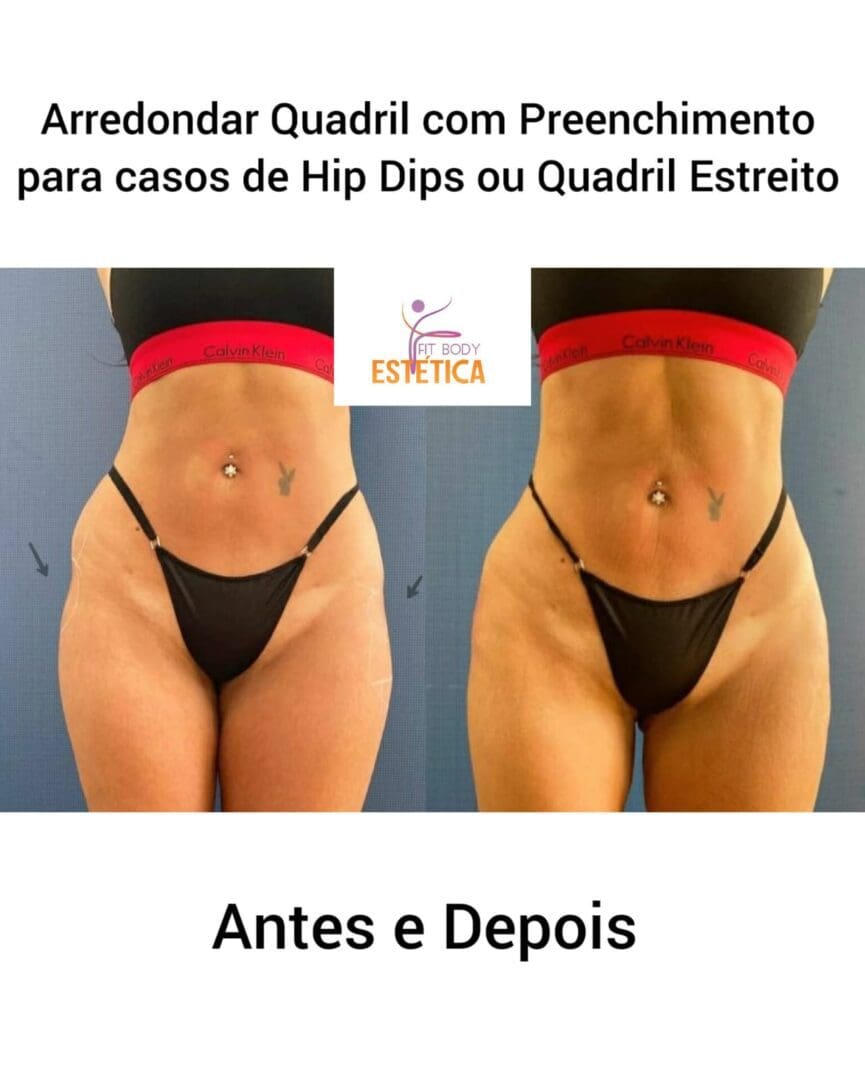 Clínica Especializada em Hip Dips - Clínica Fit Body Estética