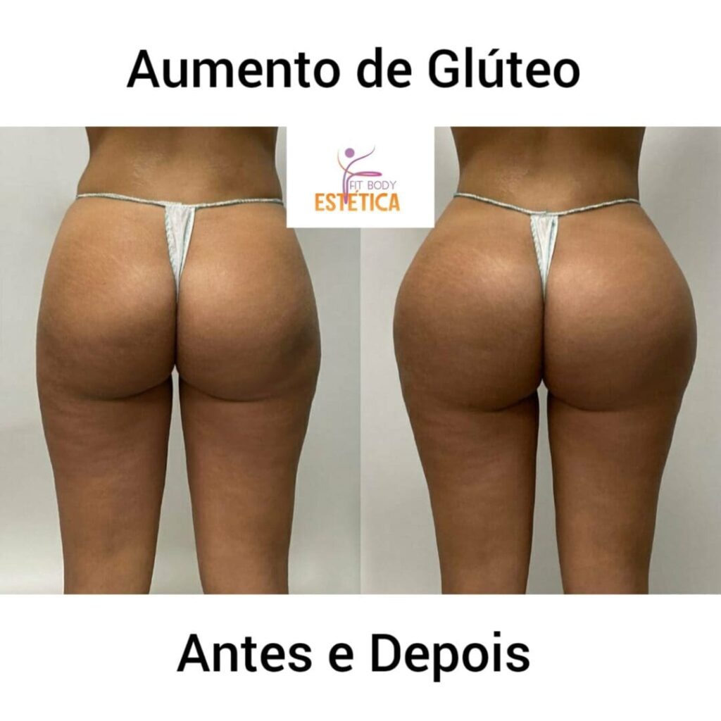 Aumento de Gluteo Resultado Antes e Depois