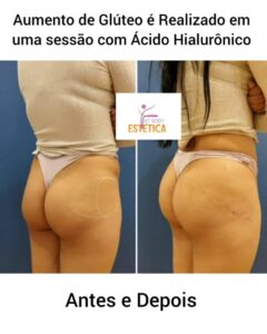 Aumento de Gluteo em Uma Sessao com Acido Hialuronico