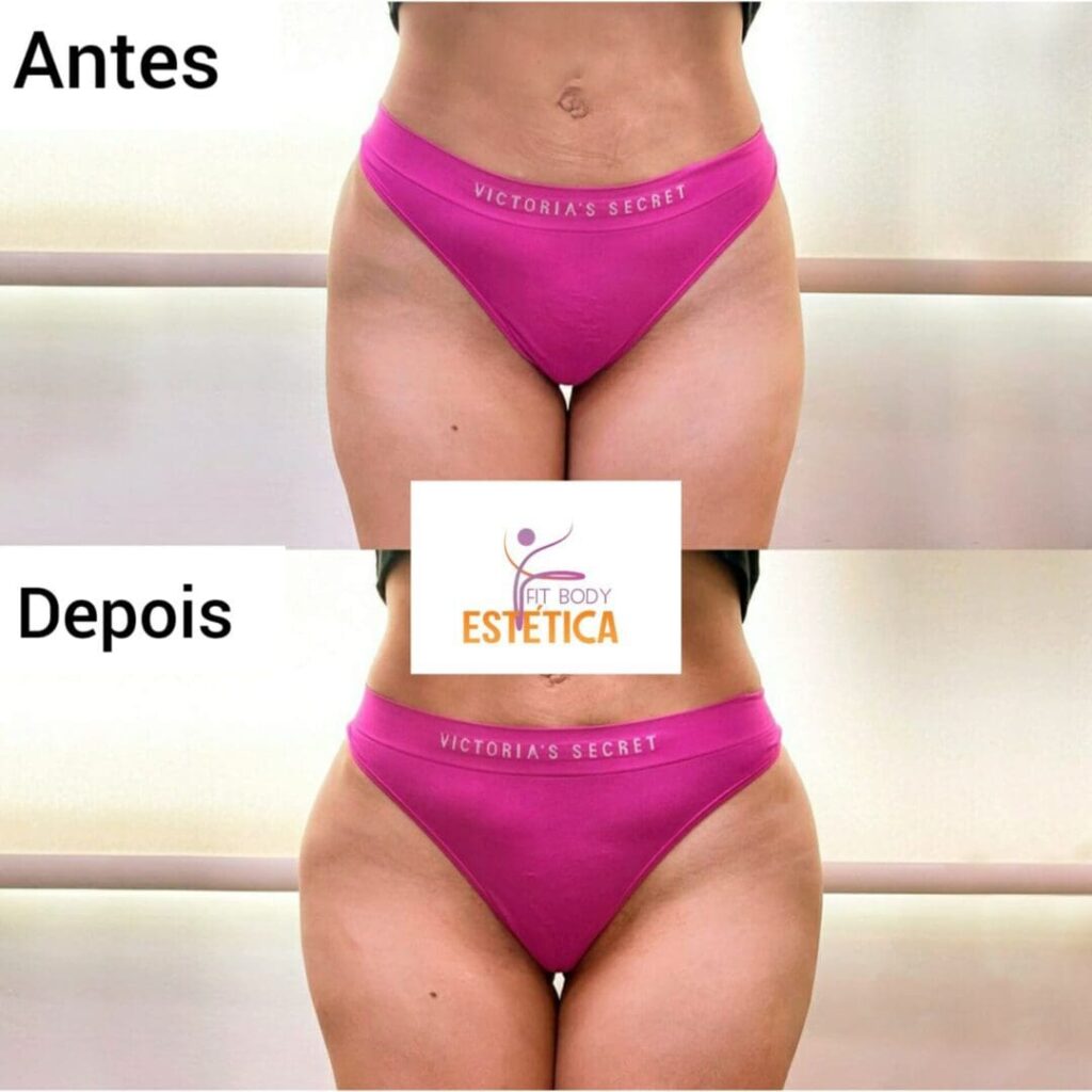 É possível acabar com o Hip Dips? - Sim, É Possível!- Clínica Fit Body  Estética