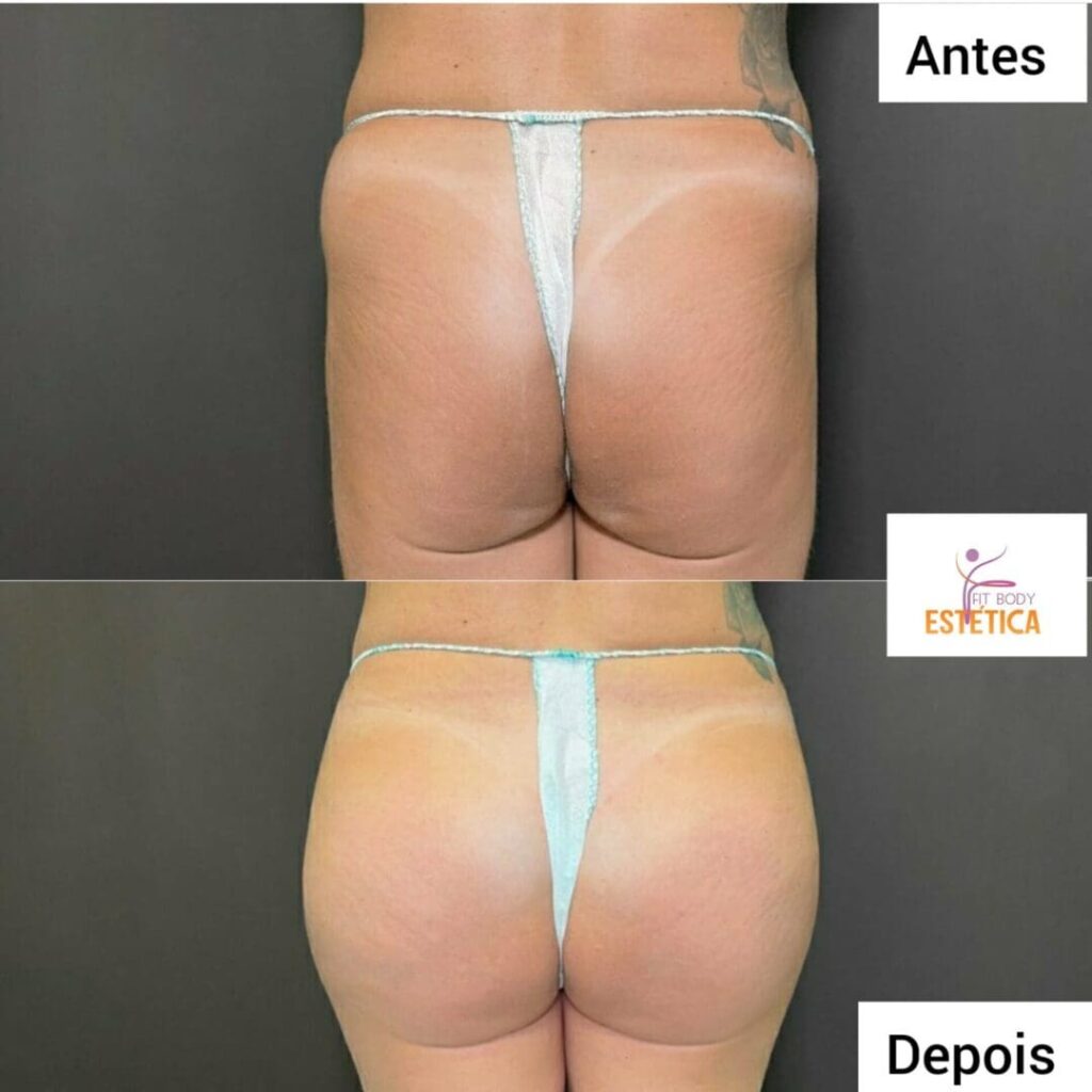 Aumento de Gluteo e Quadril Antes e Depois