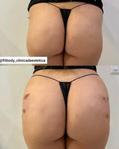 Aumento de Gluteos Cuidados Pos Procedimento