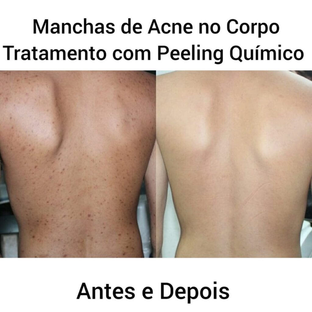 Manchas de Acne no Corpo Tratamento Antes e Depois