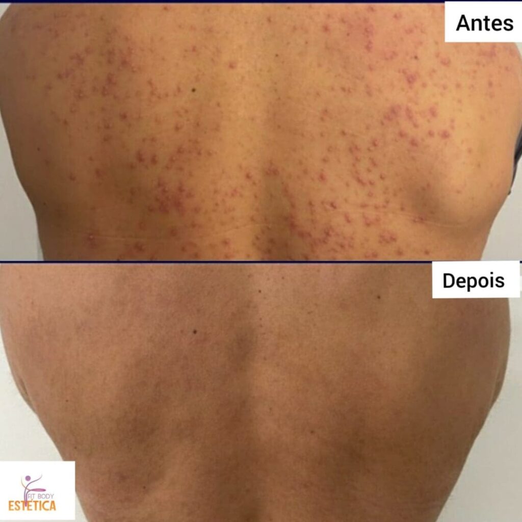 Peeling Quimico para tratar Manchas de Acne nas Costas