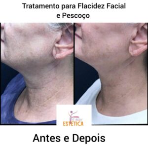 Tratamento para Flacidez Facial e Pescoco