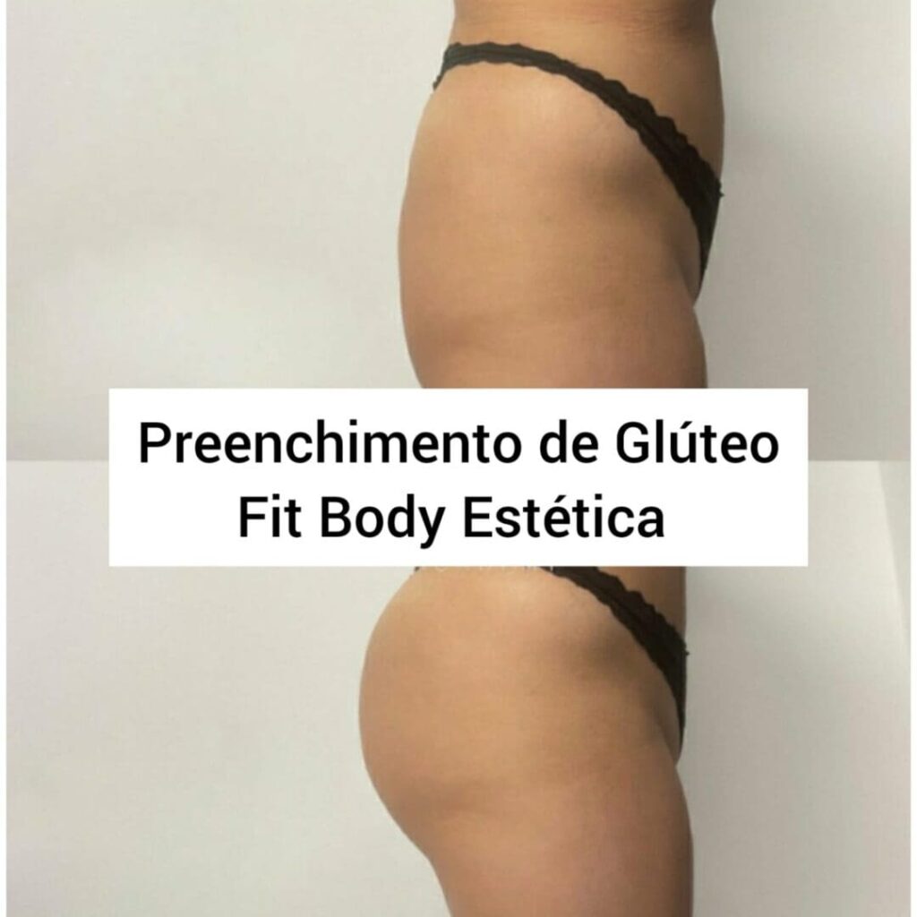 Aumento de Gluteos com Preenchimento Antes e Depois