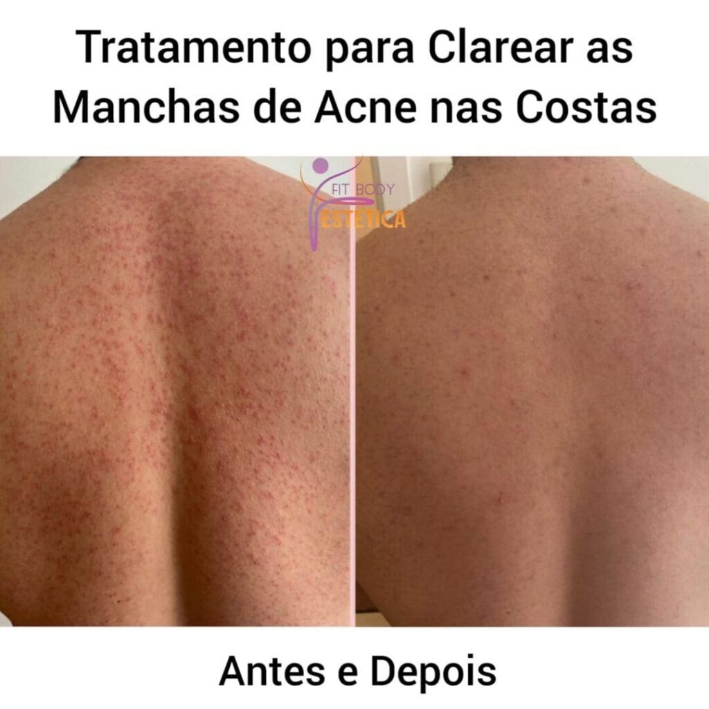 Clarear Manchas de Acne nas Costas Tratamento