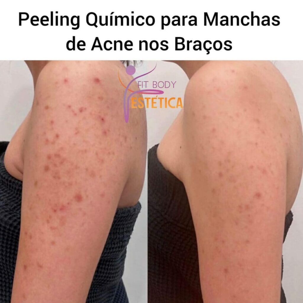 Peeling Quimico para Manchas de Acne nos Bracos