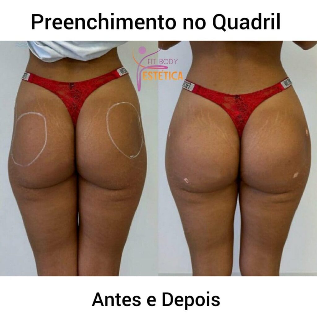 Clínica Especializada em Hip Dips - Clínica Fit Body Estética