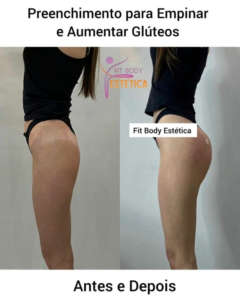 Preenchimento para Empinar e Aumentar Gluteos