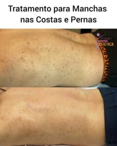 Tratamento para Manchas nas Costas e Pernas