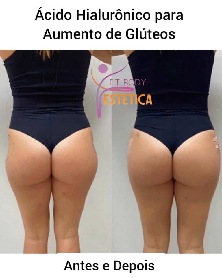 Acido Hialuronico para Aumento de Gluteos