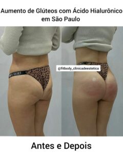 Aumento de Gluteos com Acido Hialuronico em Sao Paulo