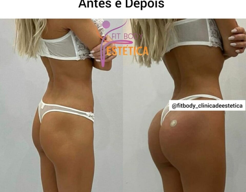 Hip Dips Preenchimento Resultado Antes e Depois