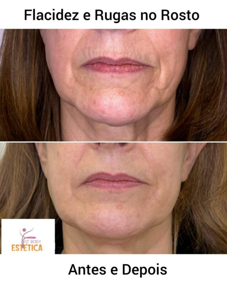 Flacidez e Rugas no Rosto Antes e Depois Clínica Fit Body Estética