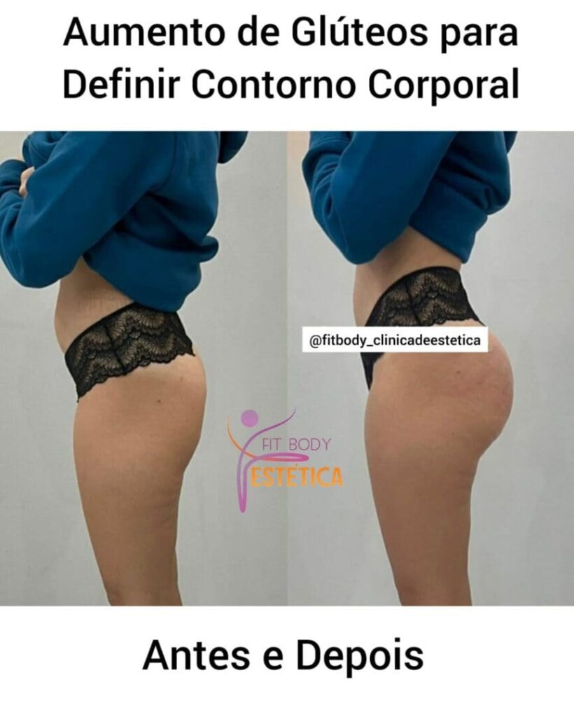 Aumento de Gluteos para Definir Contorno Corporal