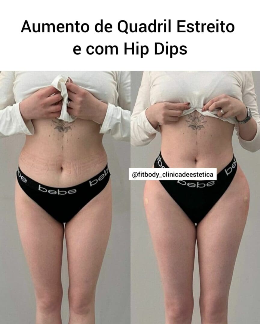 Hip Dips Antes E Depois