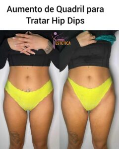 Preenchimento Lateral de Quadril Hip Dips - Fit Body Estética