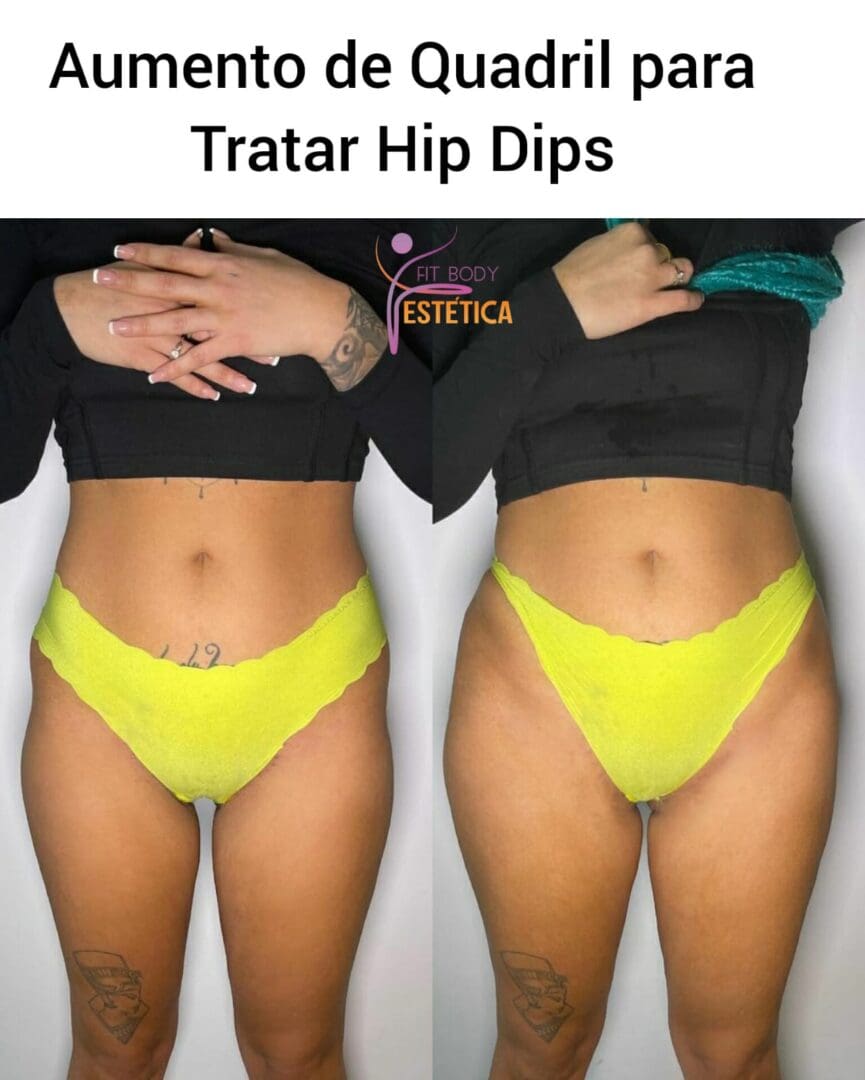 Aumento de Quadril Estreito e com Hip Dips - Fit Body Estético