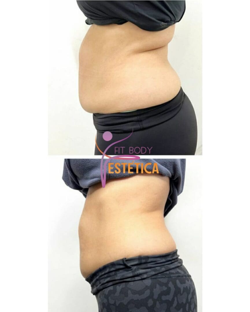 Enzimas Para Gordura Localizada Na Barriga Fit Body Estética