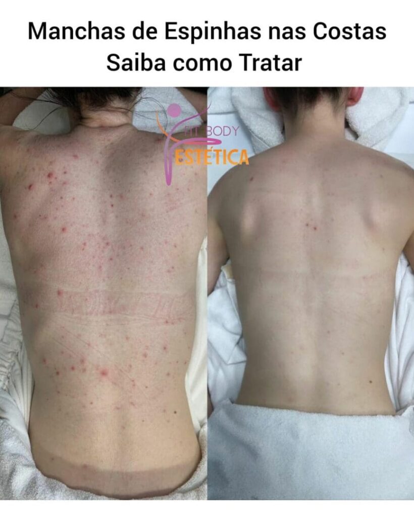 Manchas de Espinhas nas Costas Saiba como Tratar