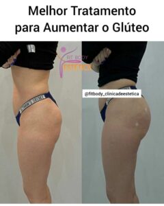 Melhor Tratamento para Aumentar o Glúteo: Antes e Depois