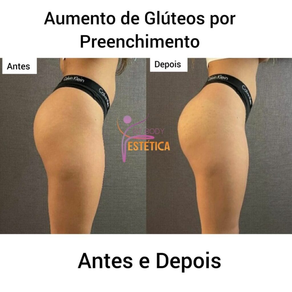 Aumento de Glúteos por Preenchimento