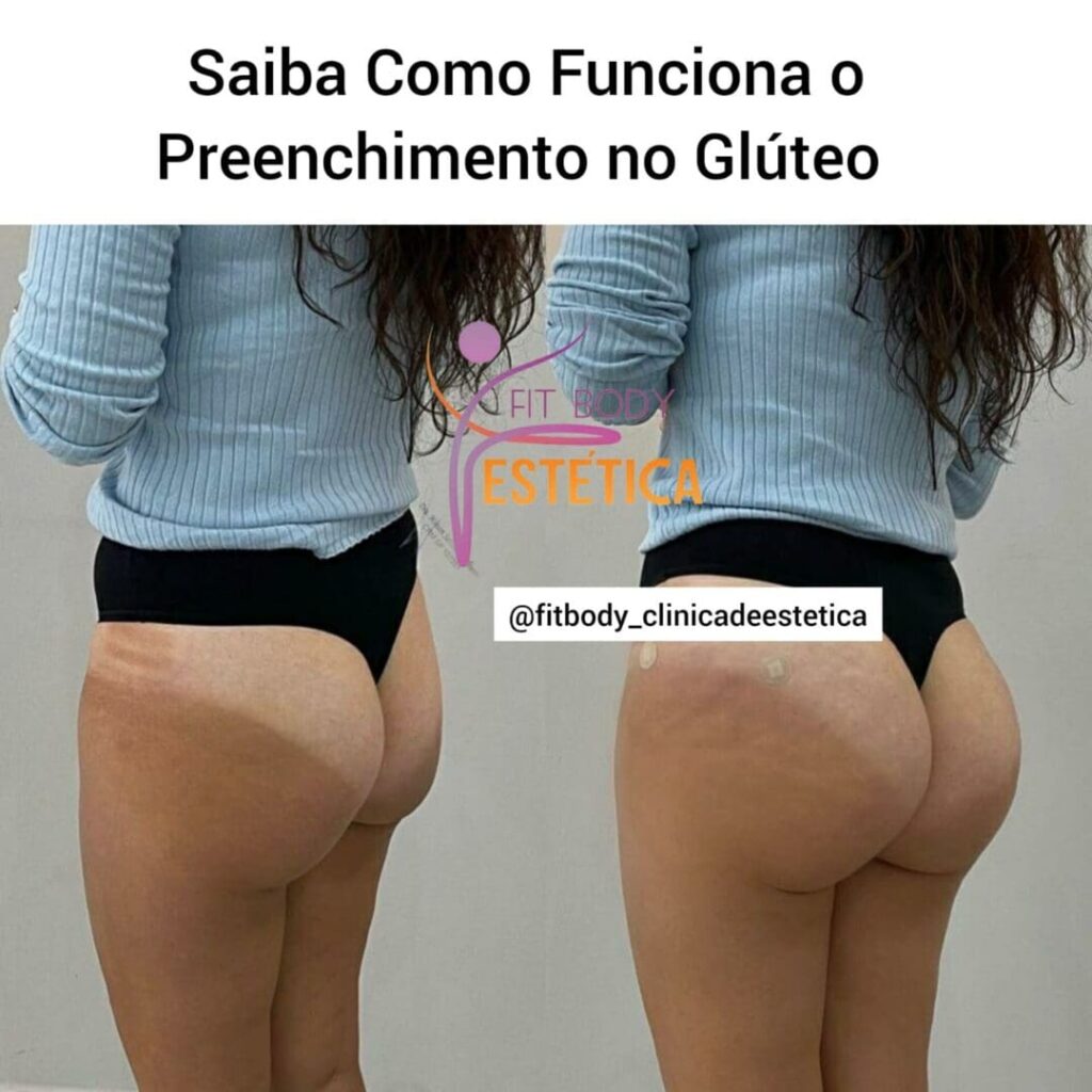 Como Funciona o Preenchimento no Glúteo